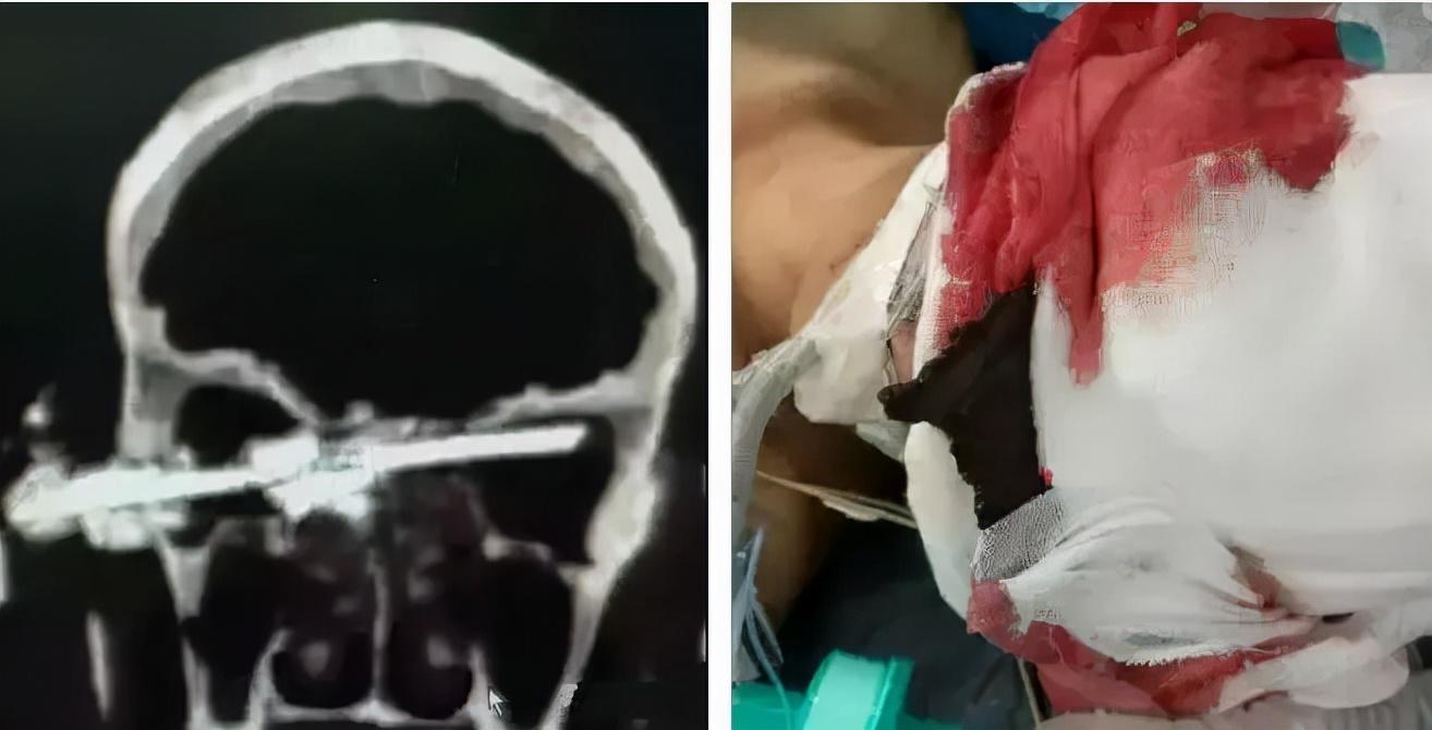 电动角磨机安全使用方法_电动角磨机伤人事故视频_电动角磨机工作原理